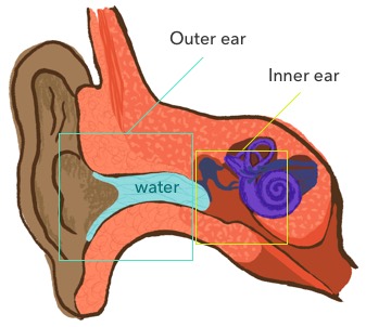 Swimmer’s Ear